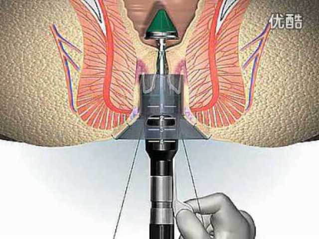 Kashid Hospital Piles Treatment Ahmednagnar
